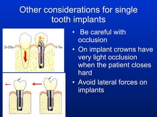 Other considerations for single tooth implants Be careful with occlusion On implant crowns have very light occlusion when the patient closes hard Avoid lateral forces on implants 