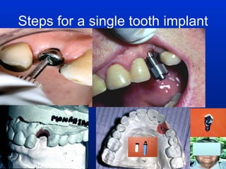 Steps for a single tooth implant 
