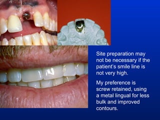 Site preparation may not be necessary if the patient’s smile line is not very high. My preference is screw retained, using a metal lingual for less bulk and improved contours. 