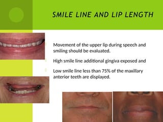 Treatment planning for the edentulous maxilla.pptx