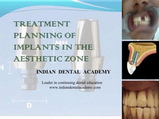 TREATMENT
PLANNING OF
IMPLANTS IN THE
AESTHETIC ZONE
INDIAN DENTAL ACADEMY
Leader in continuing dental education
www.indiandentalacademy.com
 
