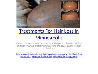 Treatments For Hair Loss in
Minneapolis
The Good Look Ink Hair Treatment Pack helps stop further hair loss
and hair thinning problems by targeting the cause and the effect
of hair loss.
hair restoration treatment, hair loss laser treatment, best hair loss
treatment, solutions for hair fall, solutions for hair growth
 