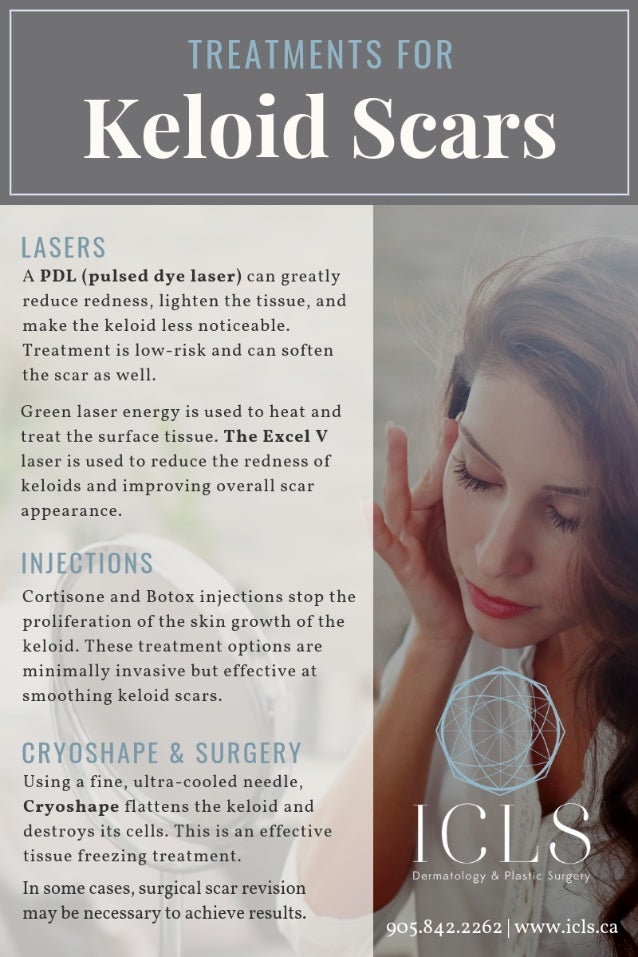 Treatments for Keloid Scars