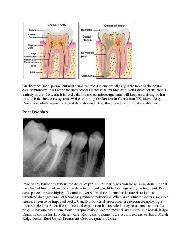 treat-your-defective-teeth-with-root-canal-treatment