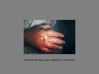 Cremada de segon grau superficial i profunda 