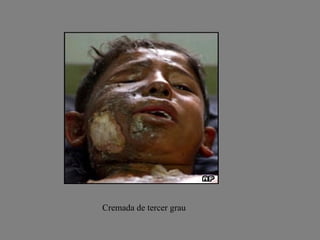 Cremada de tercer grau 