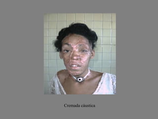 Cremada càustica 