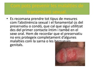 Com pots prevenir les malalties de
        transmissió sexual.
• Es recomana prendre tot tipus de mesures
  com l’abstinència sexual i el fonamental ús del
  preservatiu o condó, que cal que sigui utilitzat
  des del primer contacte íntim i també en el
  sexe oral. Hem de recordar que el preservatiu
  no ens protegeix completament d’algunes
  malalties com la sarna o les berrugues
  genitals.
 