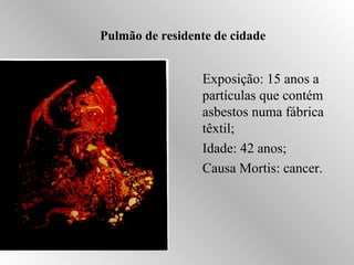 Pulmão de residente de cidade 
Exposição: 15 anos a 
partículas que contém 
asbestos numa fábrica 
têxtil; 
Idade: 42 anos; 
Causa Mortis: cancer. 
 
