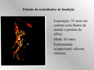 Pulmão do trabalhador de fundição 
Exposição: 35 anos em 
contato com fumos de 
metais e poeiras de 
sílica; 
Idade: 63 anos; 
Enfermidade 
ocupacional: silicose 
clássica. 
 