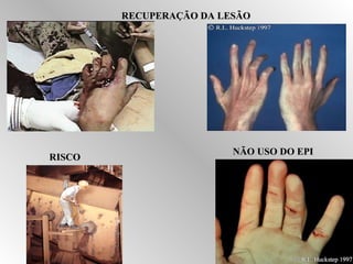 RREECCUUPPEERRAAÇÇÃÃOO DDAA LLEESSÃÃOO 
RRIISSCCOO NNÃÃOO UUSSOO DDOO EEPPII 
 