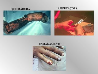 QQUUEEIIMMAADDUURRAA AAMMPPUUTTAAÇÇÕÕEESS 
EESSMMAAGGAAMMEENNTTOO 
 