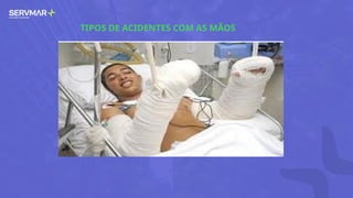TIPOS DE ACIDENTES COM AS MÃOS
 