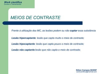 MEIOS DE CONTRASTE Frente à utilização dos MC, as lesões podem ou não  captar  essa substância Lesão hipercaptante : lesão que capta muito o meio de contraste;  Lesão hipocaptante : lesão que capta pouco o meio de contraste;  Lesão não captante :lesão que não capta o meio de contraste;  