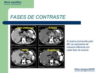 FASES DE CONTRASTE Sem contraste Arterial Portal Excretora O realce promovido pelo MC se apresenta de maneira diferente em cada fase do exame 