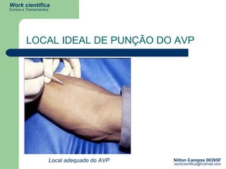 LOCAL IDEAL DE PUNÇÃO DO AVP Local adequado do AVP 