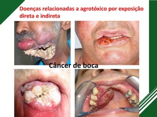 Câncer de boca
Doenças relacionadas a agrotóxico por exposição
direta e indireta
 