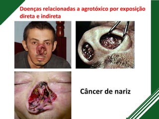 Câncer de nariz
Doenças relacionadas a agrotóxico por exposição
direta e indireta
 