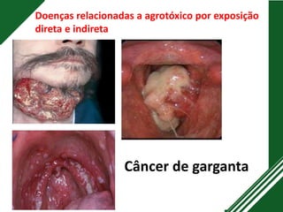 Doenças relacionadas a agrotóxico por exposição
direta e indireta
Câncer de garganta
 