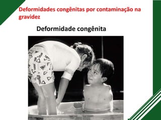Deformidades congênitas por contaminação na
gravidez
Deformidade congênita
 