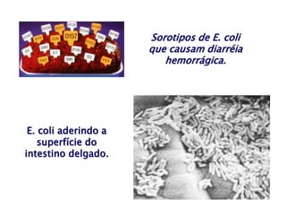 Sorotipos de E. coli
que causam diarréia
hemorrágica.
E. coli aderindo a
superfície do
intestino delgado.
 