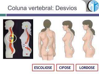 Coluna vertebral: Desvios
CIFOSEESCOLIOSE LORDOSE
 