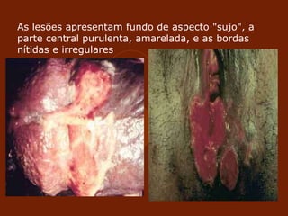 As lesões apresentam fundo de aspecto "sujo", a
parte central purulenta, amarelada, e as bordas
nítidas e irregulares
 