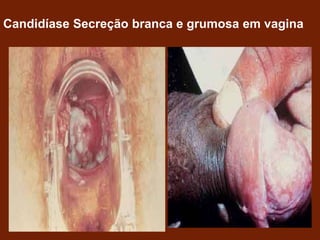 Candidíase Secreção branca e grumosa em vagina
 