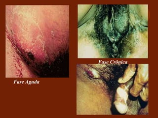Fase Aguda
Fase Crônica
 