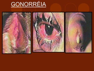 GONORRÉIA
 