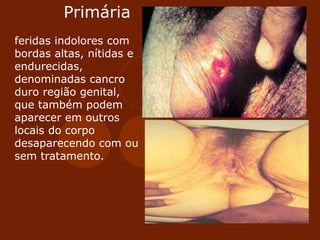 Primária
feridas indolores com
bordas altas, nítidas e
endurecidas,
denominadas cancro
duro região genital,
que também podem
aparecer em outros
locais do corpo
desaparecendo com ou
sem tratamento.
 