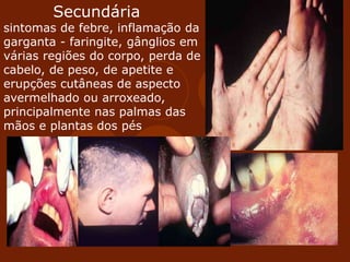 Secundária
sintomas de febre, inflamação da
garganta - faringite, gânglios em
várias regiões do corpo, perda de
cabelo, de peso, de apetite e
erupções cutâneas de aspecto
avermelhado ou arroxeado,
principalmente nas palmas das
mãos e plantas dos pés
 