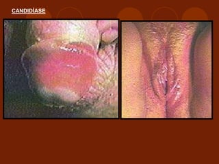 CANDIDÍASE
 