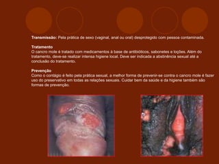 Transmissão: Pela prática de sexo (vaginal, anal ou oral) desprotegido com pessoa contaminada.
Tratamento
O cancro mole é tratado com medicamentos à base de antibióticos, sabonetes e loções. Além do
tratamento, deve-se realizar intensa higiene local. Deve ser indicada a abstinência sexual até a
conclusão do tratamento.
Prevenção
Como o contágio é feito pela prática sexual, a melhor forma de prevenir-se contra o cancro mole é fazer
uso do preservativo em todas as relações sexuais. Cuidar bem da saúde e da higiene também são
formas de prevenção.
 