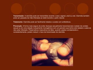 Transmissão: A clamídia pode ser transmitida durante o sexo vaginal, anal ou oral. Clamídia também
pode ser passada da mãe infectada ao bebê durante o parto natural.
Tratamento: Clamídia pode ser facilmente tratada e curada com antibióticos.
Prevenção: A forma mais segura de evitar doenças sexualmente transmissíveis é abster de contato
sexual ou ter uma relação mutuamente monogâmica com um parceiro que tenha sido testado e sabe-se
não estar infectado. Preservativos masculinos de látex, quando usados corretamente e
consistentemente, podem reduzir o risco da transmissão de clamídia.
 