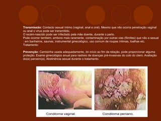 Transmissão: Contacto sexual íntimo (vaginal, anal e oral). Mesmo que não ocorra penetração vaginal
ou anal o virus pode ser transmitido.
O recém-nascido pode ser infectado pela mãe doente, durante o parto.
Pode ocorrer também, embora mais raramente, contaminação por outras vias (fômites) que não a sexual
: em banheiros, saunas, instrumental ginecológico, uso comum de roupas íntimas, toalhas etc.
Tratamento:
Prevenção: Camisinha usada adequadamente, do início ao fim da relação, pode proporcionar alguma
proteção. Exame ginecológico anual para rastreio de doenças pré-invasivas do colo do útero. Avaliação
do(a) parceiro(a). Abstinência sexual durante o tratamento.
 