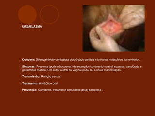 UREAPLASMA
Conceito: Doença infecto-contagiosa dos órgãos genitais e urinários masculinos ou femininos.
Sintomas: Presença (pode não ocorrer) de secreção (corrimento) uretral escassa, translúcida e
geralmente matinal. Um ardor uretral ou vaginal pode ser a única manifestação.
Transmissão: Relação sexual
Tratamento: Antibiótico oral
Prevenção: Camisinha, tratamento simultâneo do(a) parceiro(a).
 