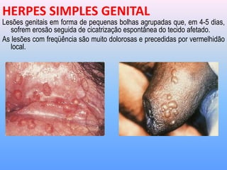 Lesões genitais em forma de pequenas bolhas agrupadas que, em 4-5 dias,
sofrem erosão seguida de cicatrização espontânea do tecido afetado.
As lesões com freqüência são muito dolorosas e precedidas por vermelhidão
local.
HERPES SIMPLES GENITAL
 