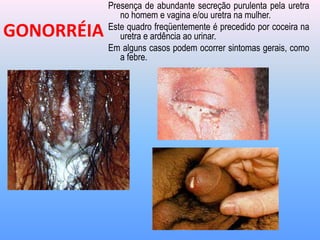 Presença de abundante secreção purulenta pela uretra
no homem e vagina e/ou uretra na mulher.
Este quadro freqüentemente é precedido por coceira na
uretra e ardência ao urinar.
Em alguns casos podem ocorrer sintomas gerais, como
a febre.
GONORRÉIA
 
