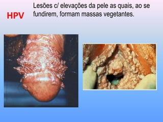 Lesões c/ elevações da pele as quais, ao se
fundirem, formam massas vegetantes.
HPV
 