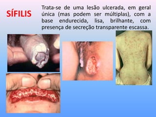 SÍFILIS
Trata-se de uma lesão ulcerada, em geral
única (mas podem ser múltiplas), com a
base endurecida, lisa, brilhante, com
presença de secreção transparente escassa.
 