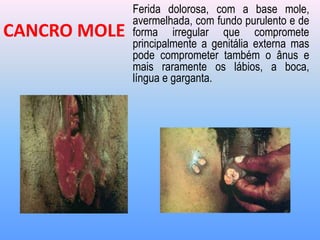 Ferida dolorosa, com a base mole,
avermelhada, com fundo purulento e de
forma irregular que compromete
principalmente a genitália externa mas
pode comprometer também o ânus e
mais raramente os lábios, a boca,
língua e garganta.
CANCRO MOLE
 