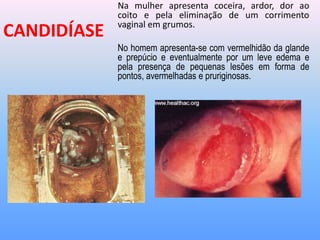 Na mulher apresenta coceira, ardor, dor ao
coito e pela eliminação de um corrimento
vaginal em grumos.
No homem apresenta-se com vermelhidão da glande
e prepúcio e eventualmente por um leve edema e
pela presença de pequenas lesões em forma de
pontos, avermelhadas e pruriginosas.
CANDIDÍASE
 