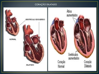CORAÇÃO DILATADO
 