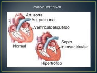 CORAÇÃO HIPERTROFIADO
 
