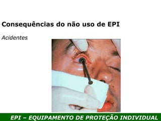 EPI – EQUIPAMENTO DE PROTEÇÃO INDIVIDUAL
Acidentes
Consequências do não uso de EPI
 