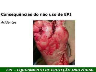 EPI – EQUIPAMENTO DE PROTEÇÃO INDIVIDUAL
Acidentes
Consequências do não uso de EPI
 