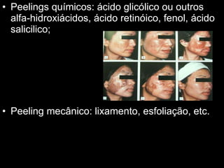 Peelings químicos: ácido glicólico ou outros alfa-hidroxiácidos, ácido retinóico, fenol, ácido salicilico; Peeling mecânico: lixamento, esfoliação, etc. 