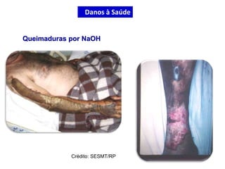 Crédito: SESMT/RP
Danos à Saúde
Queimaduras por NaOH
 