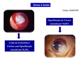 Lesão de Esclerótica e
Córnea com Opacificação
causada por H2SO4
Opacificação de Córnea
causada por NaOCl
Crédito: SESMT/RP
Danos à Saúde
 